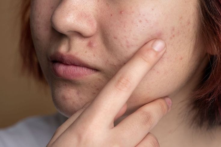 Apa Itu Skintype? Berikut Panduan Memilih Facial Wash Agar Kulit Bebas Beruntusan