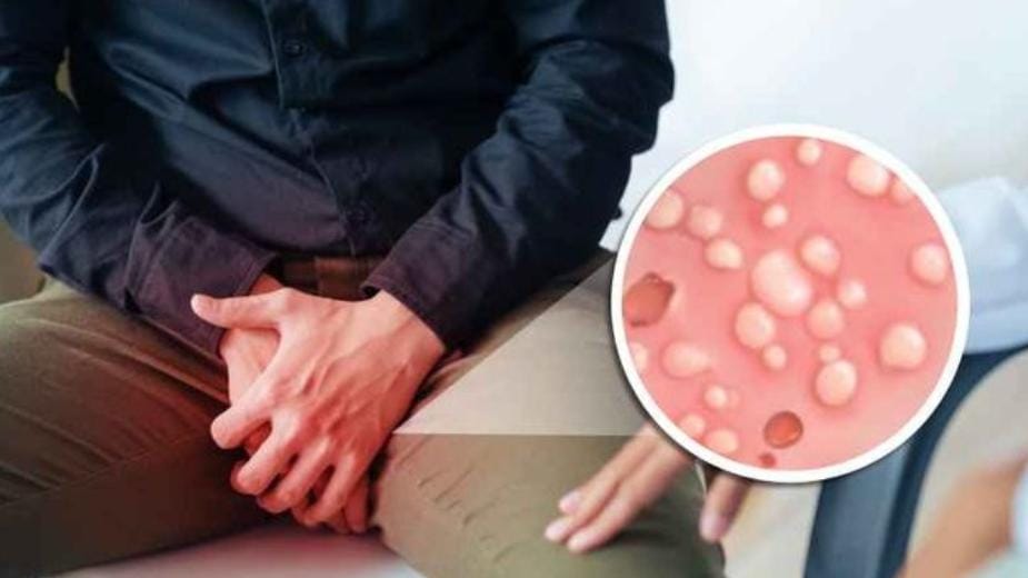 Mengenal Kutu Pubis dan Cara Menghilangkannya