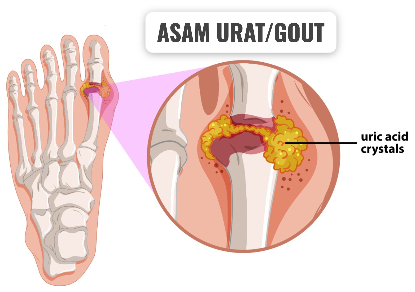 Ini Dia Penyebab Penyakit Asam Urat dari Segi Akhlak dan Hati Menurut Ustad Dhanu