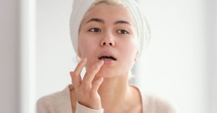 Ilustrasi bibir kering.
