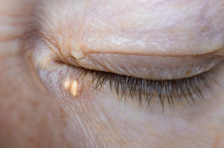 Xanthelasma
