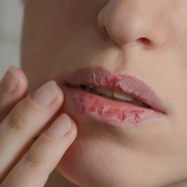 Ilustrasi bibir kering
