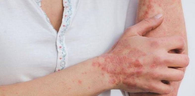 Ilustrasi sindrom steven johnsons (foto: asian parents)