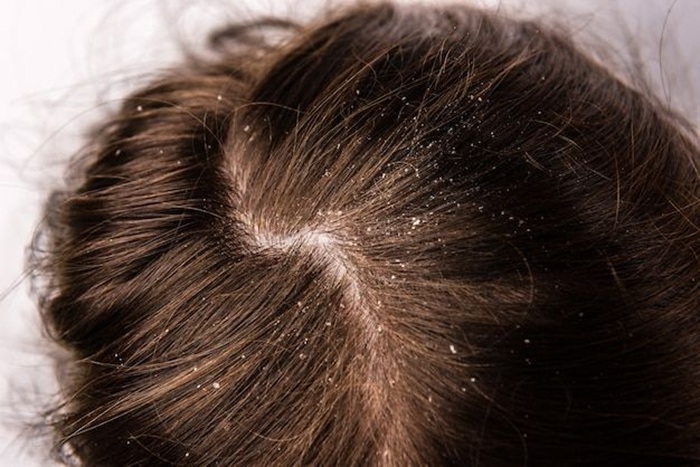 Rambut Berketombe