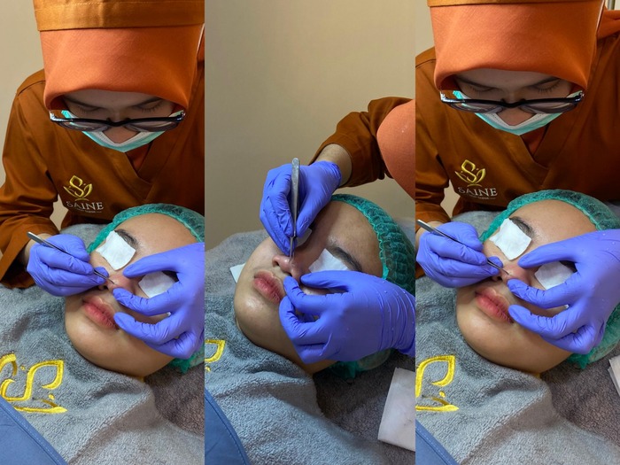 Menghilangkan komedo di klinik kecantikan