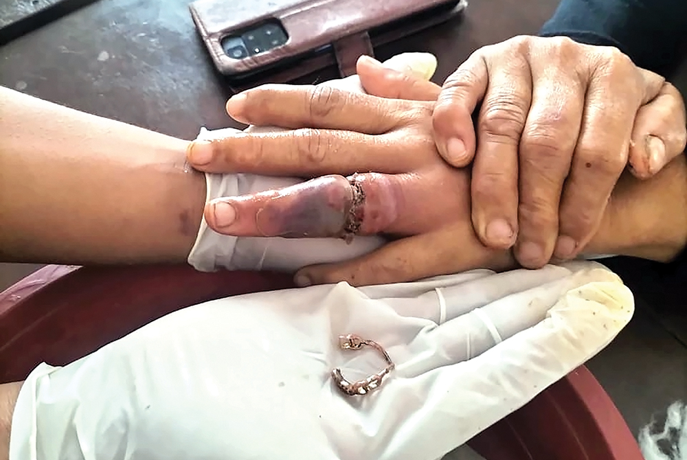 KESAKITAN: Petugas Damkarmat Nganjuk berhasil melepas cincin yang menbuat jari Rani Winarsih bengkak selama lima bulan.