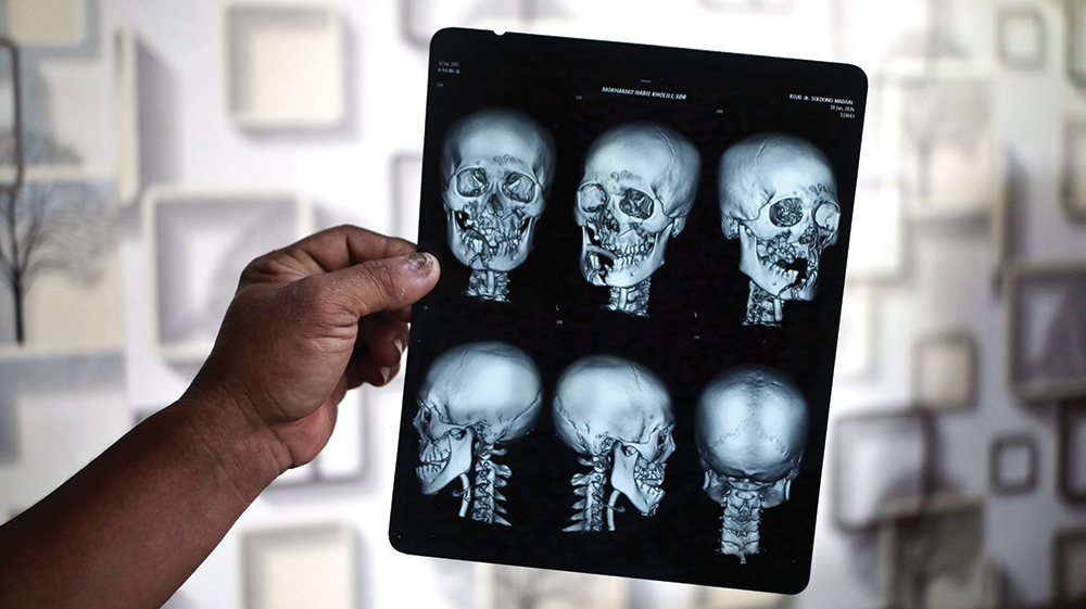 LUKA PARAH: Siti Kunizakiah menunjukkan foto rontgen M. Nabil Kholili, adiknya yang memperlihatkan rahang remuk karena dihantam bata ringan dan dikeroyok.