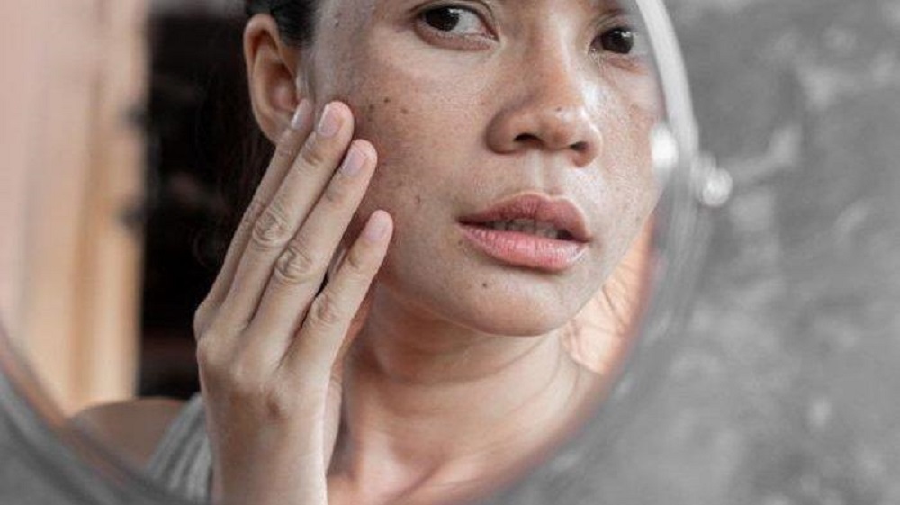 Flek hitam di wajah mengganggu penampilan dan rasa percaya diri.