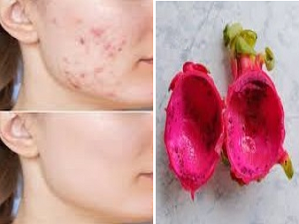 Kulit buah naga mampu membantu mencegah terjadinya jerawat pada area wajah. Kandungan yang berperan dalam hal ini adalah vitamin C.