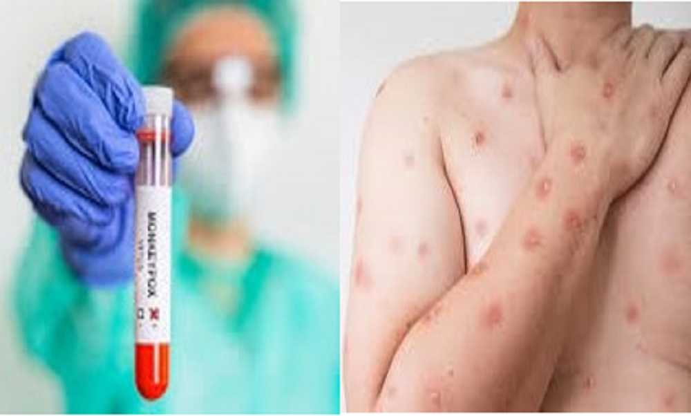 Virus cacar monyet atau Monkeypox (Mpox) dalam sepekan ini menghebohkan masyarakat.