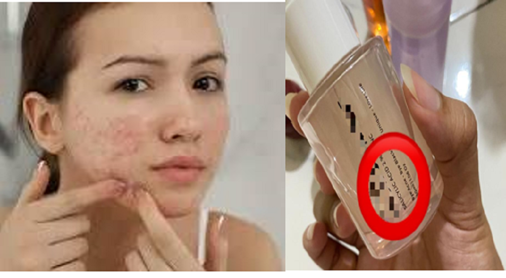 Salicylic acid merupakan salah satu bahan aktif yang kerap hadir di dalam bahan skincare sebagai produk eksfoliasi.