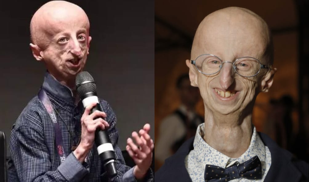 Sammy Basso Penderita Genetik Langka Progeria yang telah tutup usia.