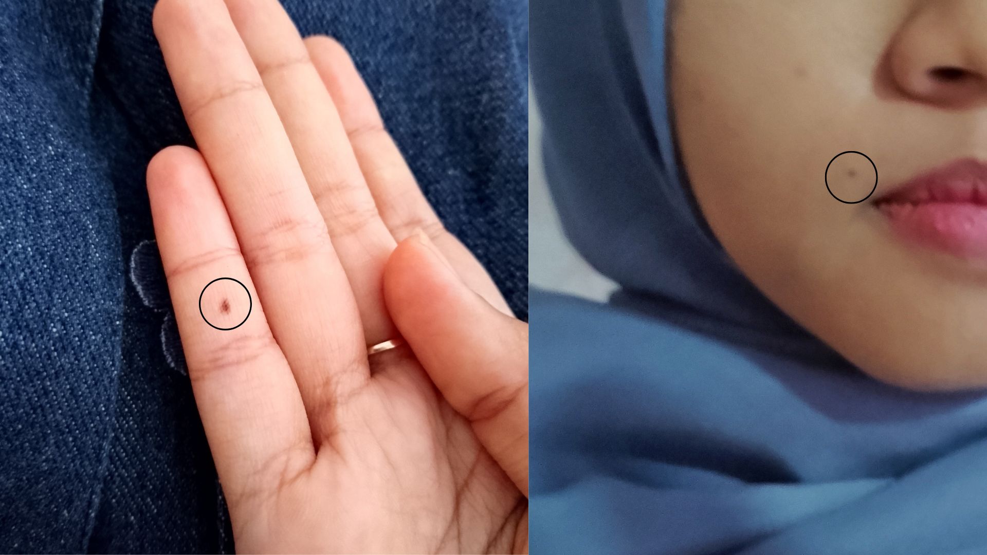 Arti tahi lalat di bagian tubuh tertentu