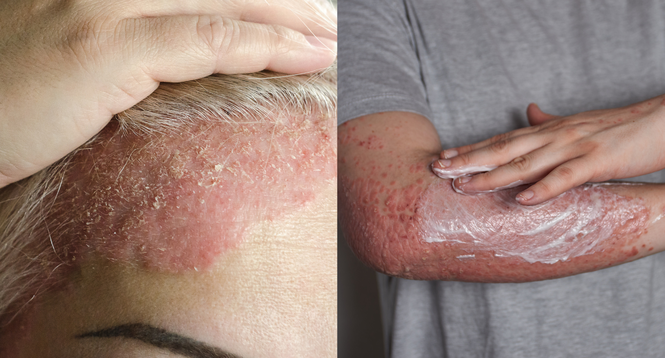 Ruam merah pada penderita psoriasis