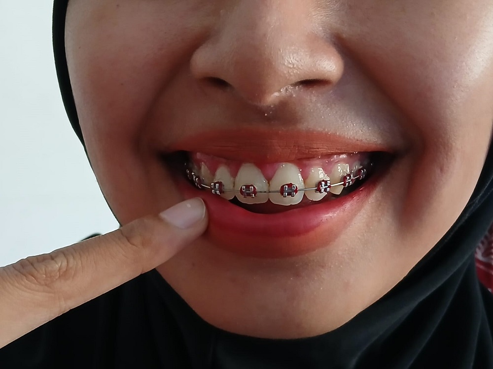 Pemasangan behel harus dengan perawatan khusus agar gigi tetap rapi dan sehat dengan senyum menawan.