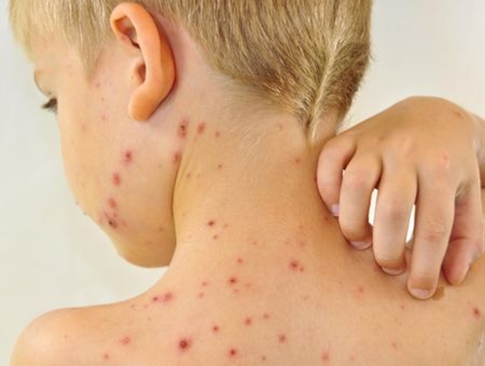 Cacar air adalah salah satu penyakit yang  disebabkan oleh infeksi virus bernama varicella zoster virus (VZV).