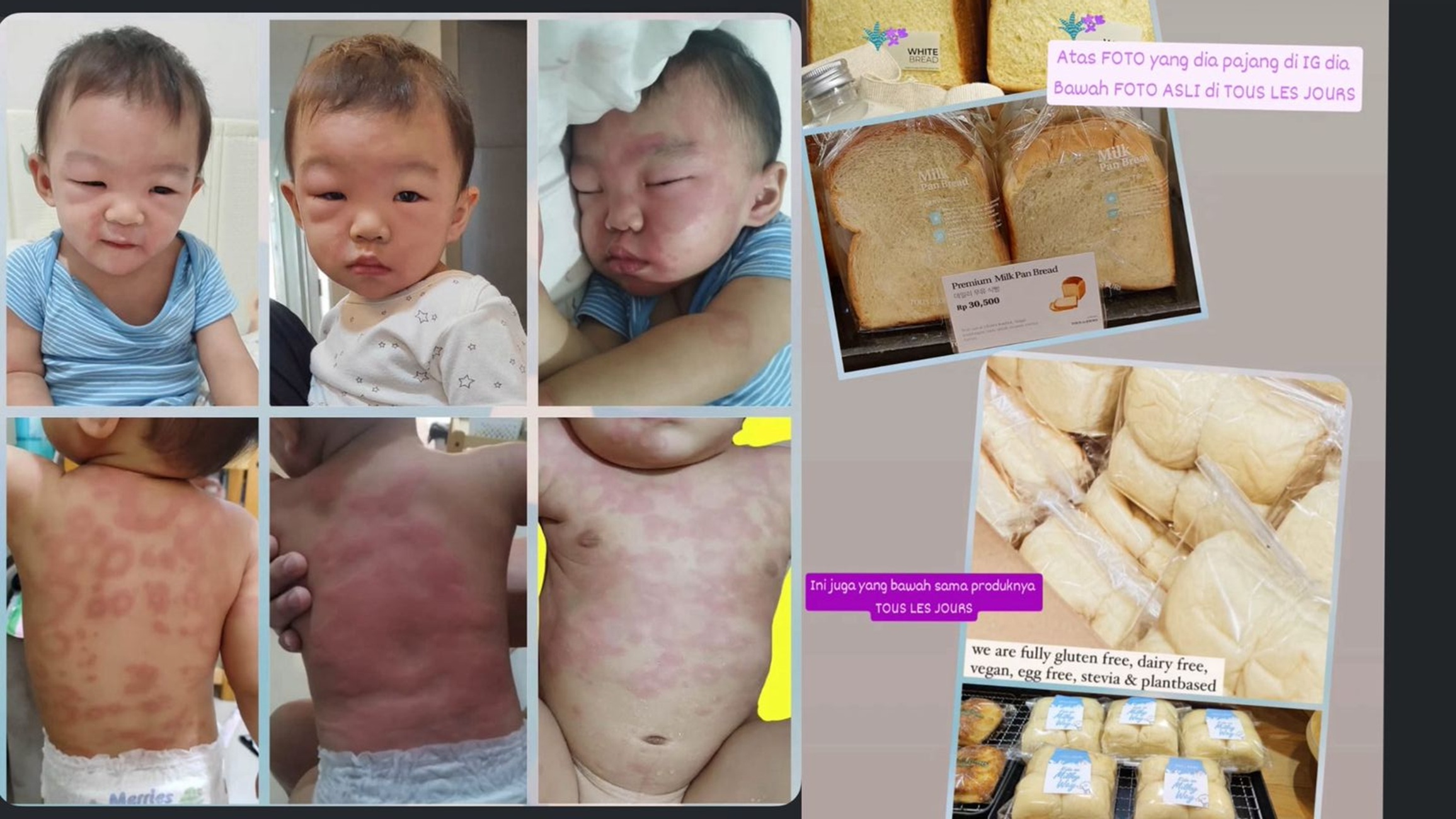 Kai, bayi 17 bulan mengalami alergi parah akibat mengonsumsi produk Bake & Grind