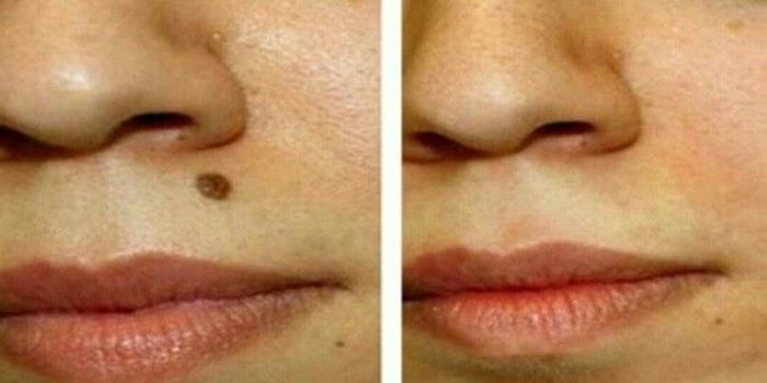 Tahi lalat adalah bintik kecil berwarna cokelat atau kehitaman yang muncul di permukaan kulit.