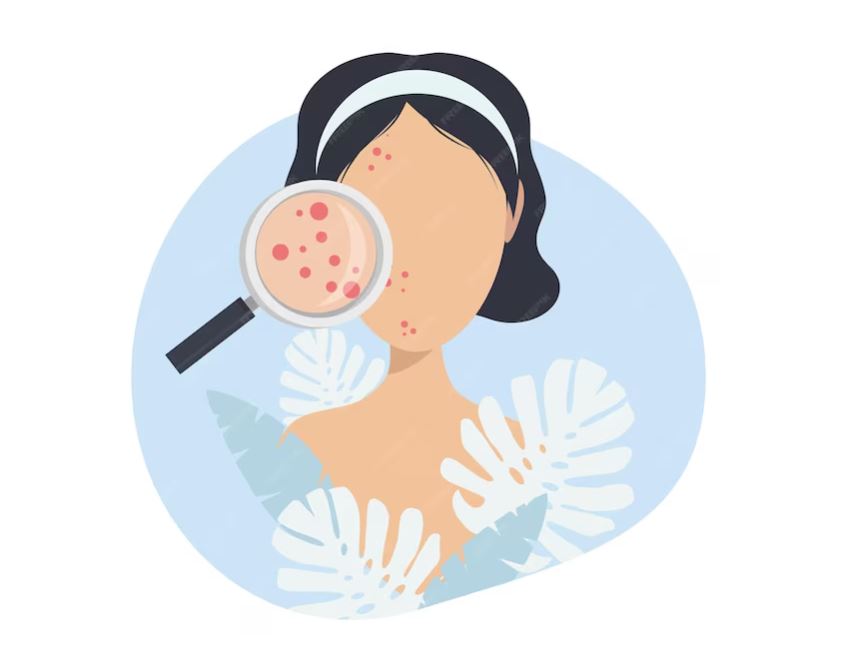 MASALAH WAJAH: Jerawat menjadi problem banyak orang. Banyak faktor penyebab, tapi juga ada cara mencegah dan menanganinya. (FREEPIK)