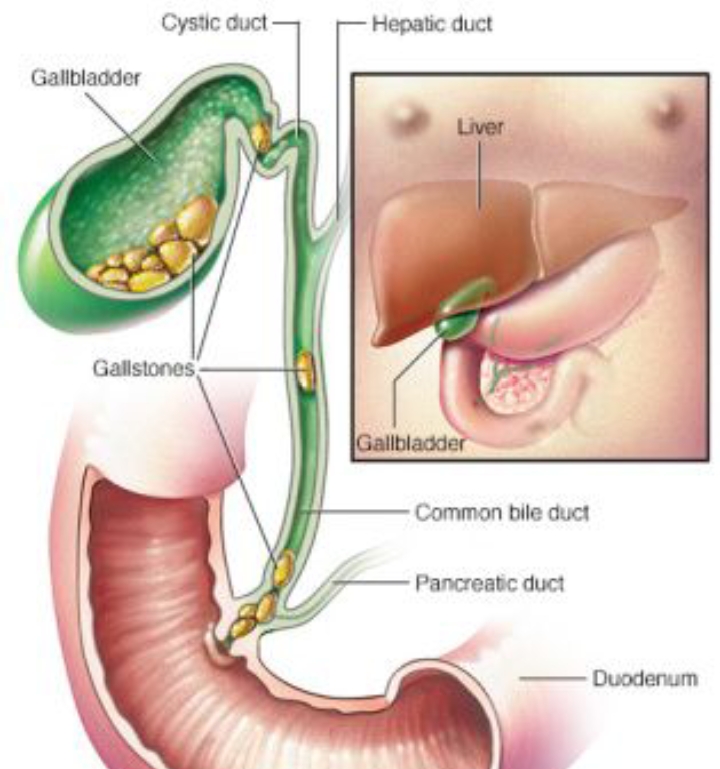 Ilustrasi batu empedu (Pinterest)