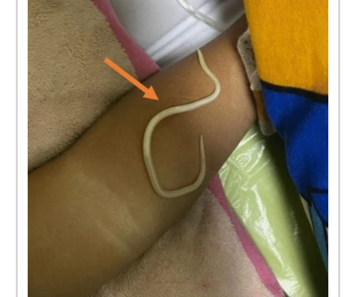 Ilustrasi, wujud cacing di dalam perut seorang balita di Jember yang telah ditangani RSD dr. Soebandi.