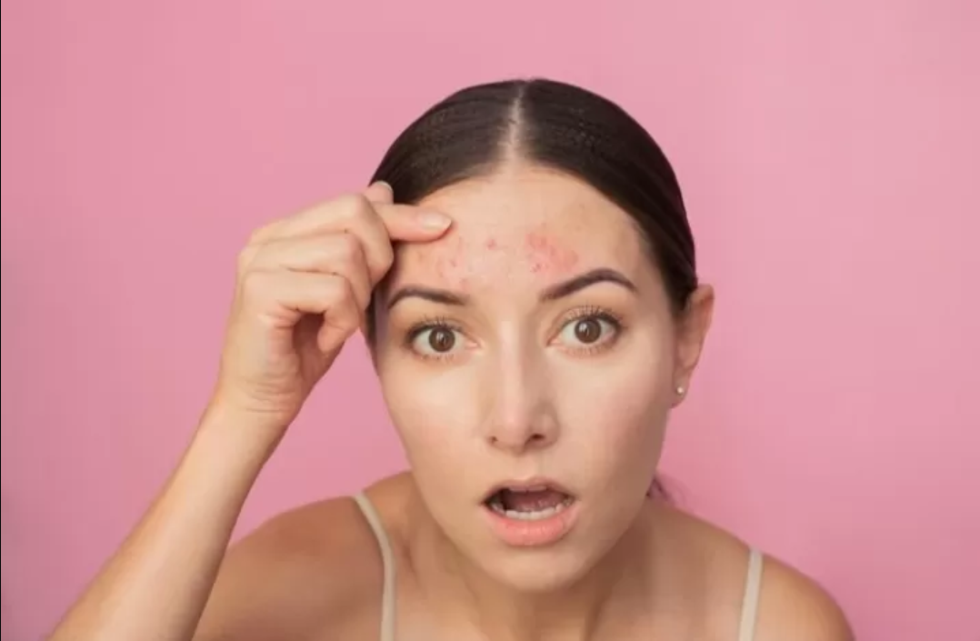Jerawat? Gak panik! Ini dia 4 skincare lokal yang siap bikin muka balik mulus kayak filter.