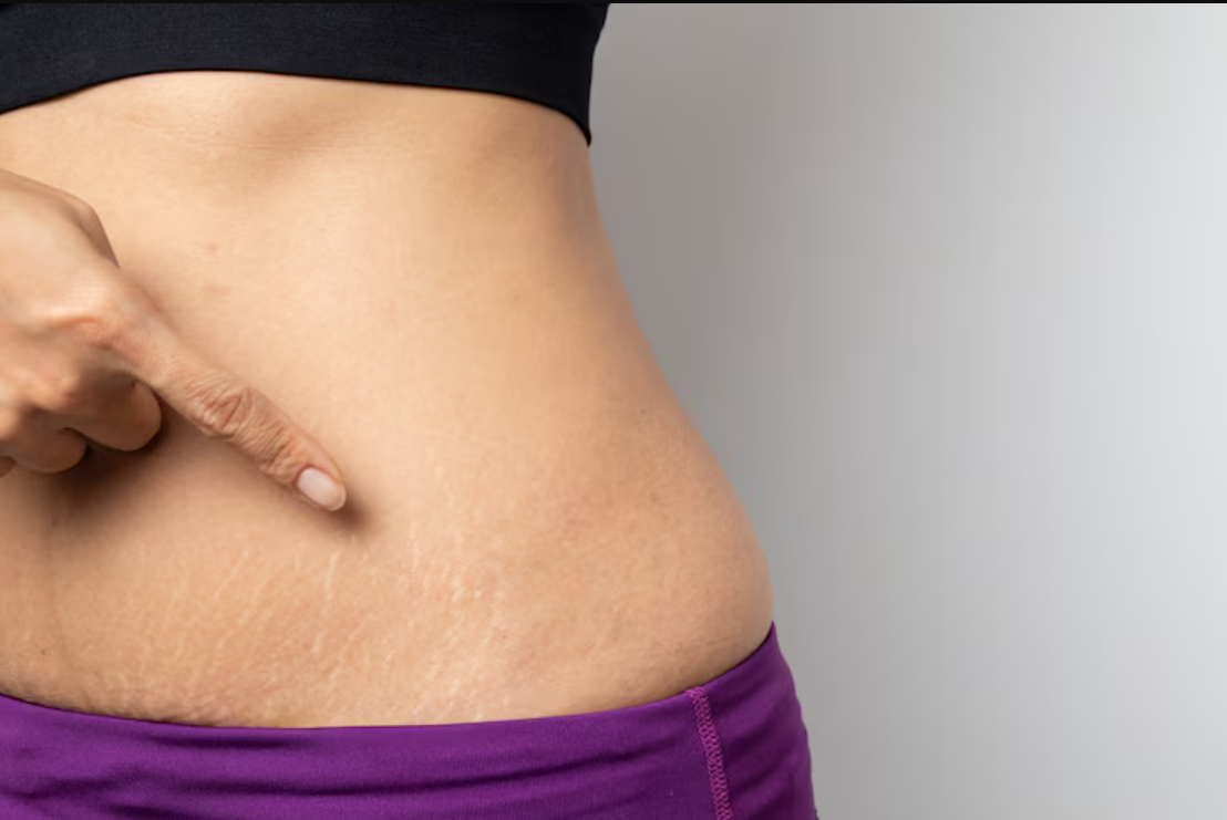 Coba lotion ini biar kulit makin mulus dan pede tanpa drama guratan stretch marks!