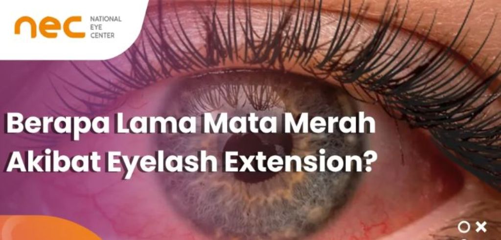 Mata Terkena Lem Eyelash.