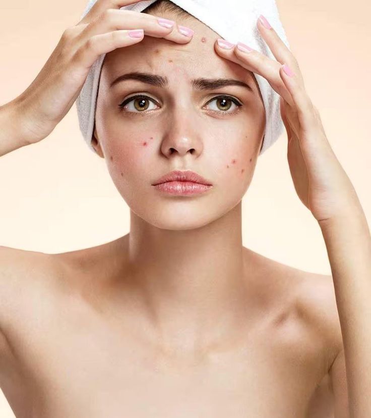 7 Kesalahan yang Bikin Jerawat Makin Parah
