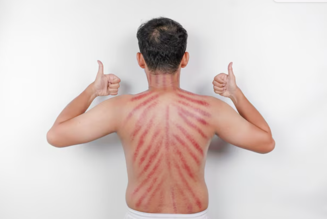 Kerokan bisa lebih dari sekadar hilangkan pegal bantu redakan nyeri, peradangan, dan gejala menopause secara alami.