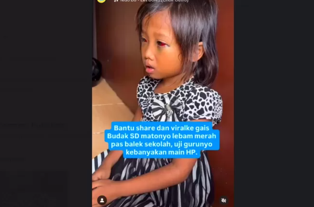 Kasus dugaan kekerasan siswi SD di Palembang viral. Korban pulang sekolah dengan mata lebam dan pembuluh darah pecah.