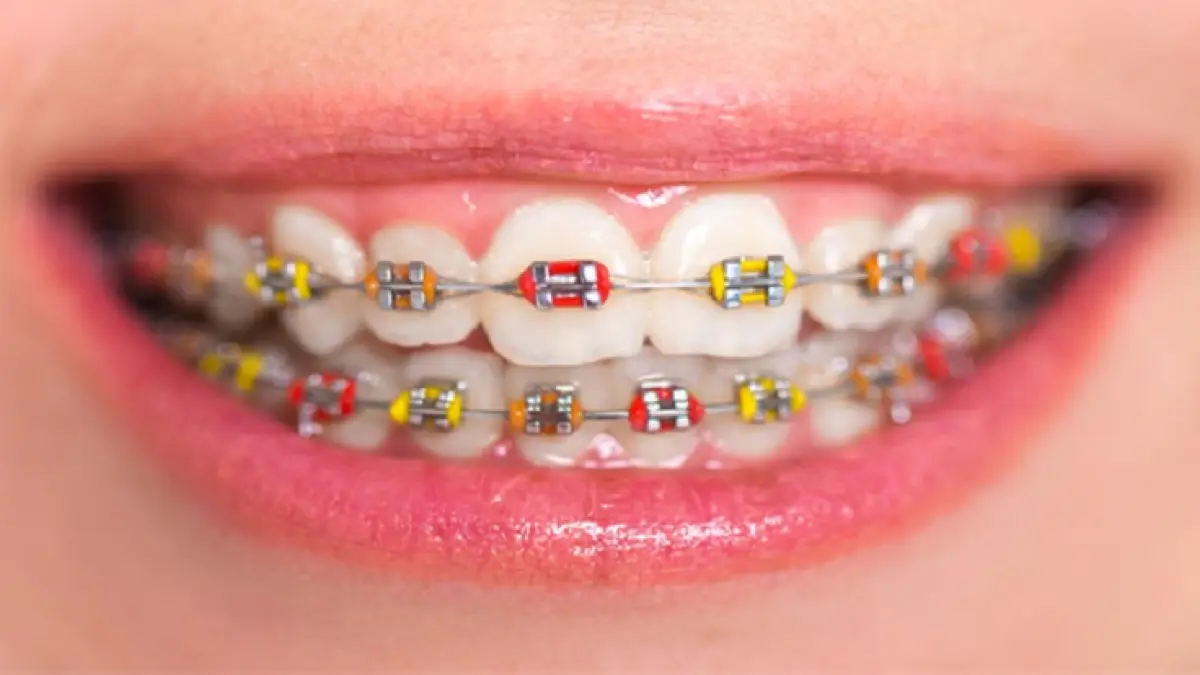 Memakai Kawat Gigi Bisa Berdampak Pada Kesehatan. Foto : Joy Dental