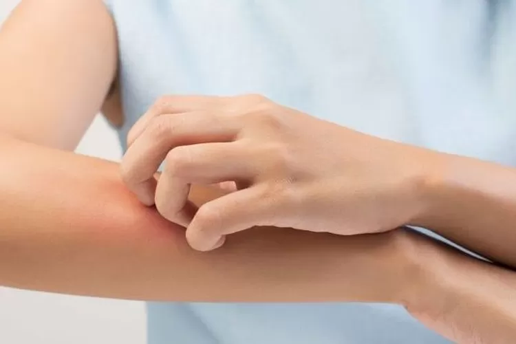 Ilustrasi kulit gatal (foto : JawaPos.com)