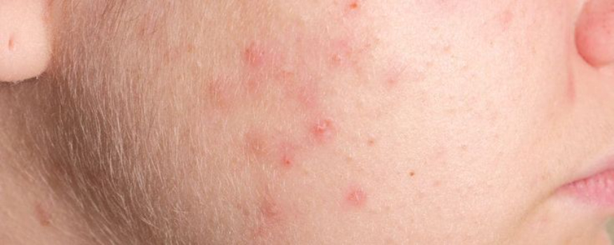 Ilustrasi kulit kemerahan (Pinterest)