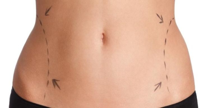 Ilustrasi Liposuction atau Sedot Lemak (Pinterest)
