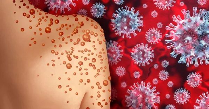 Ilustrasi virus mpox. Foto: Pinterest