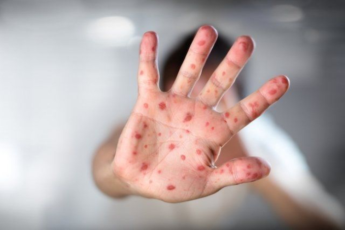 (Vaksin Covid-19 diduga penyebab Mpox. Foto: Pinterest)