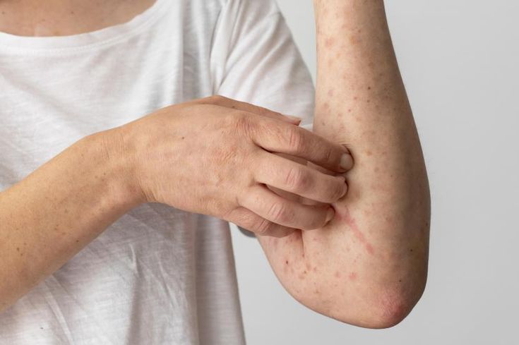 (Gejala Mpox. Foto: Pinterest)
