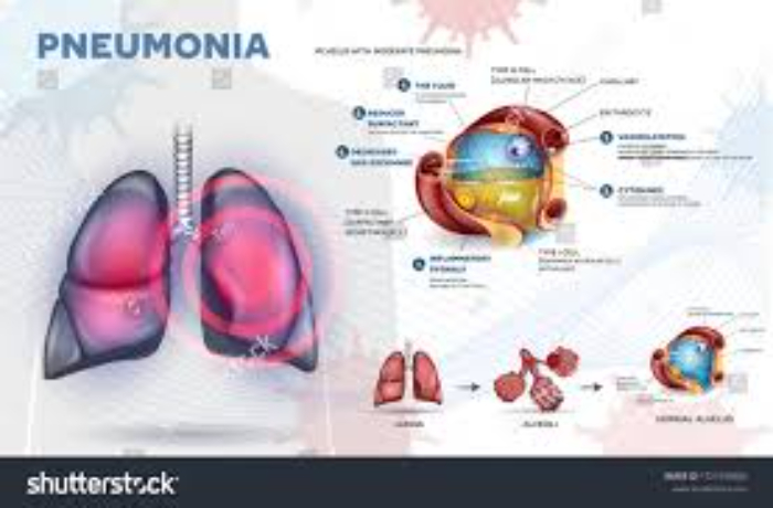 Ilustrasi Pneumonia (Pinterest)