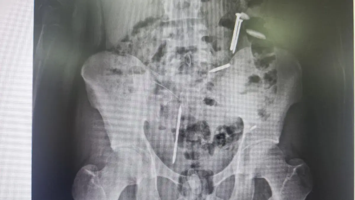 Hasil rontgen dalam tubuh pemuda di Jember. Ditemukan 5 benda aneh di dalamnya. (UPT Liposos Dinsos P3A Jember)