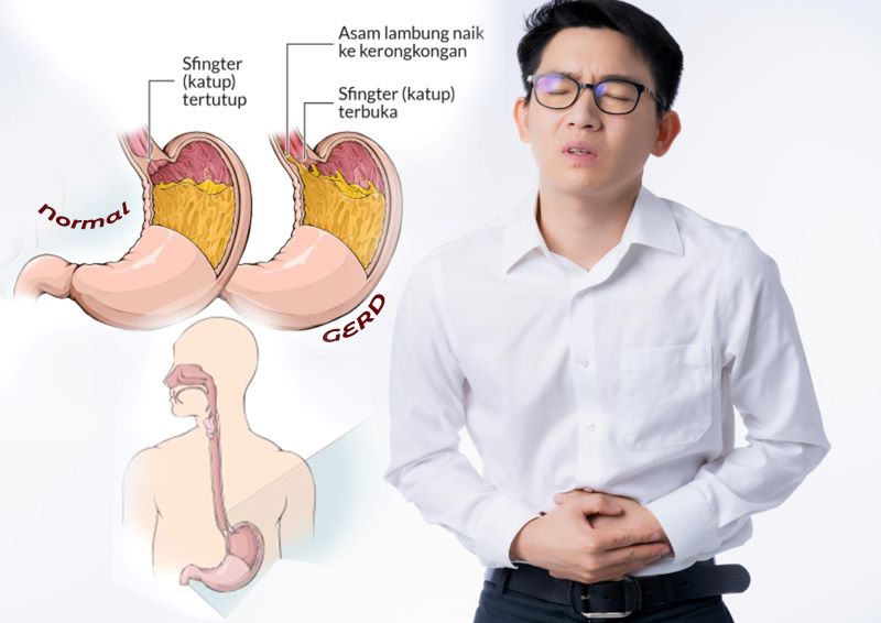 Ilustrasi aeorang pria kumat, asam lambung naik.
