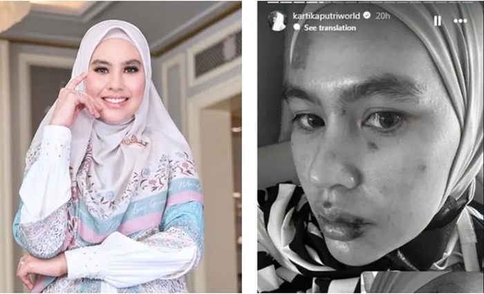 Kartika Putri alami penyakit misterius luka di wajah dan rongga mulut.