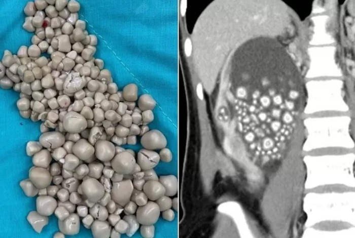 Lebih dari 300 batu ginjal yang terbentuk di tubuh Wanita asal Taiwan.