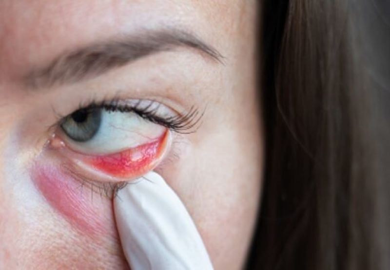 Ilustrasi Mata Bintitan.