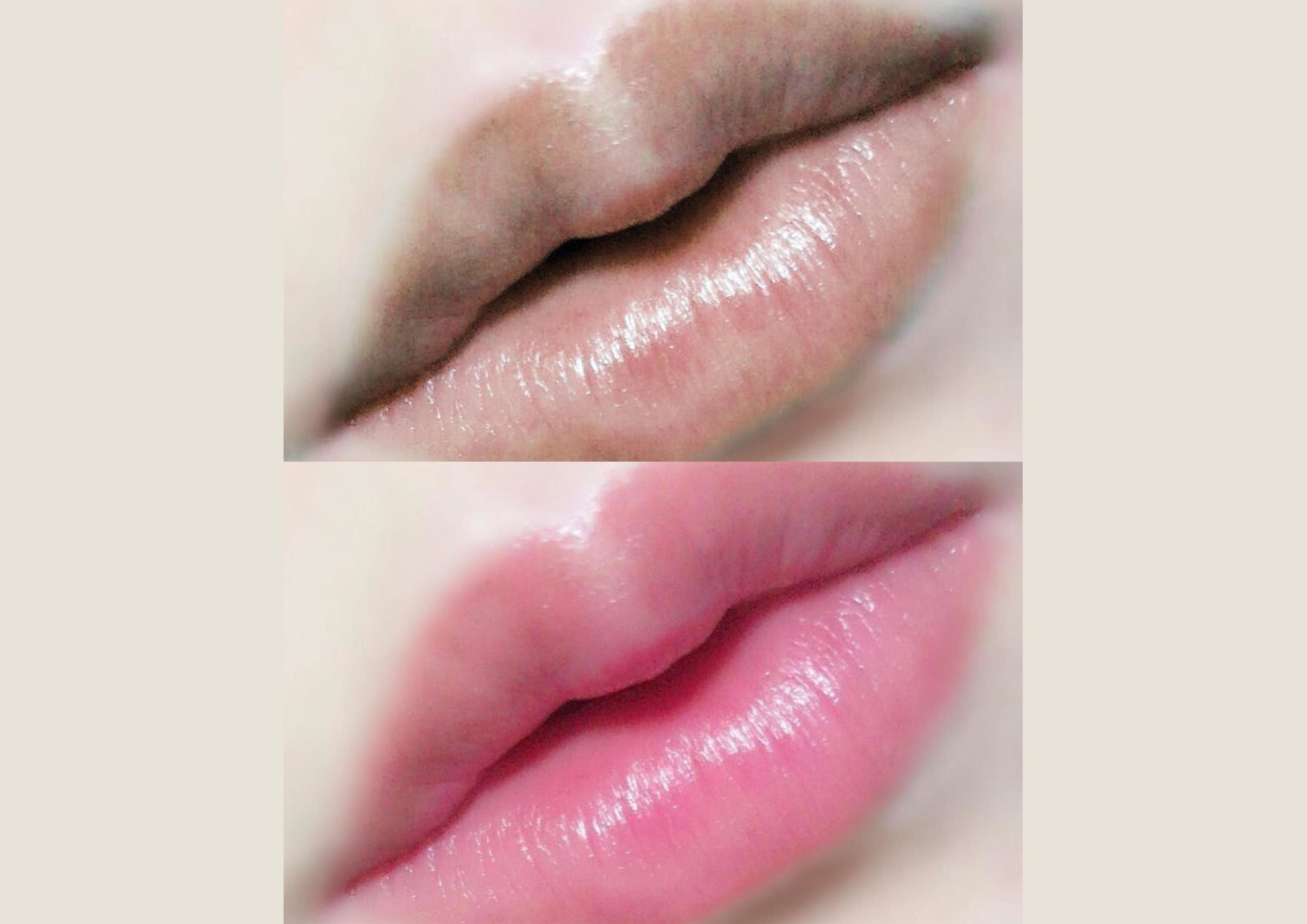 Ilustrasi bibir gelap vs pink alami.