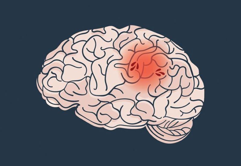 Kenali Tanda Gejala Awal Terkena Stroke.