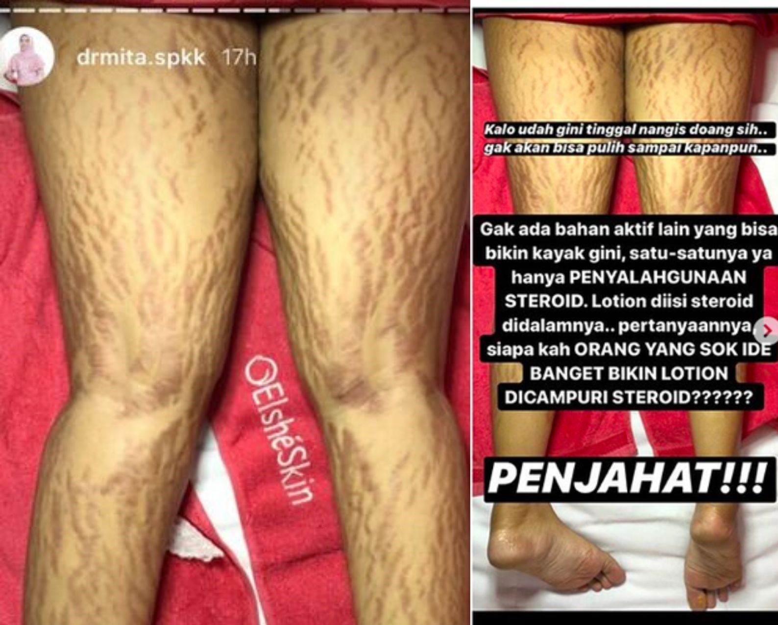 Stretchmark akibat penggunaan lotion mengandung steroid.