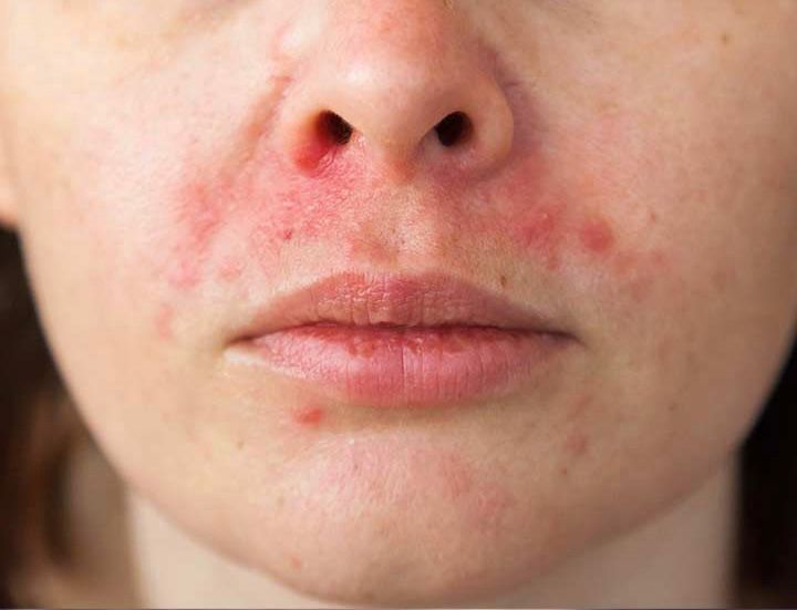 Ilustrasi Dermatitis Perioral Akibat Skincare.