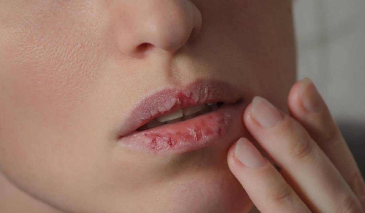 Bibir kering dan mengelupas (artofit.org)