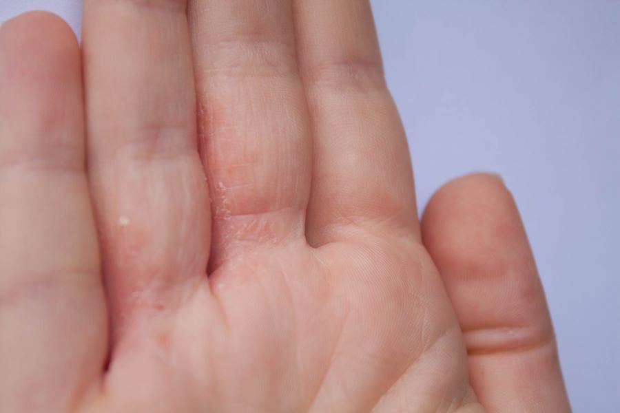 Penyakit pada kulit yang terkadang kumat.